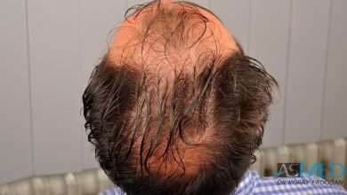 hair-implants-turkey (1)