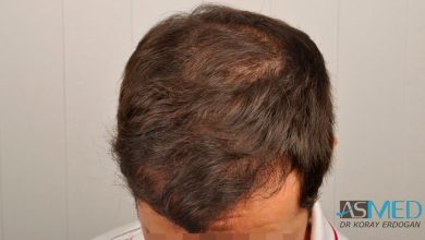 hair-implants-turkey (10)