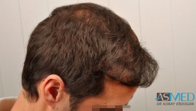 hair-implants-turkey (12)
