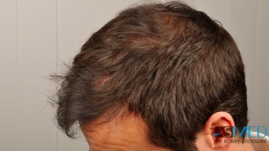 hair-implants-turkey (14)