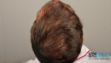 hair-implants-turkey (15)