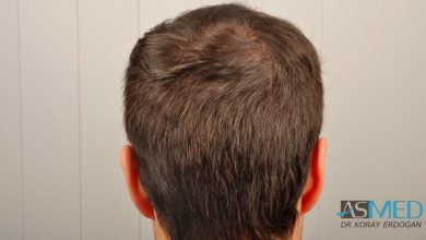 hair-implants-turkey (16)