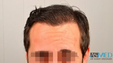 hair-implants-turkey (17)