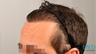 hair-implants-turkey (18)