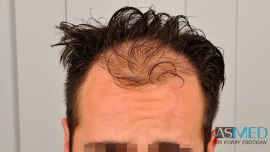 hair-implants-turkey (19)