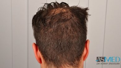 hair-implants-turkey (2)