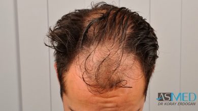 hair-implants-turkey (20)