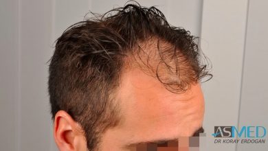 hair-implants-turkey (21)