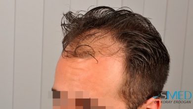 hair-implants-turkey (22)