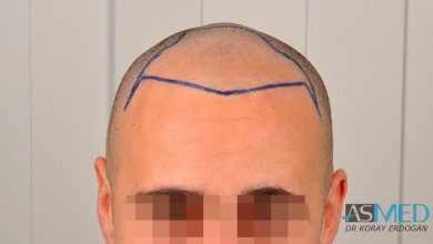 hair-implants-turkey (3)