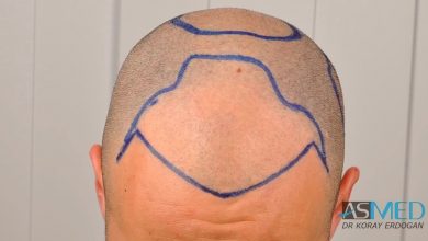 hair-implants-turkey (4)