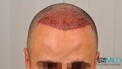 hair-implants-turkey (5)