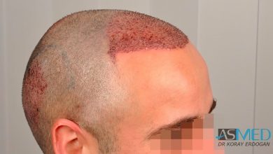 hair-implants-turkey (6)