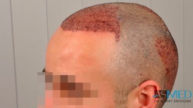 hair-implants-turkey (7)