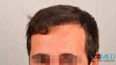hair-implants-turkey (9)