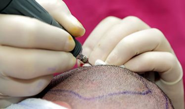 hair-treatment-turkey