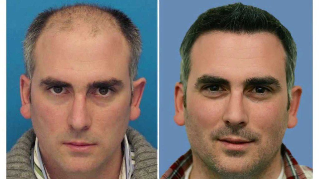 istanbul-hair-transplant