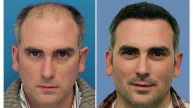 istanbul-hair-transplant