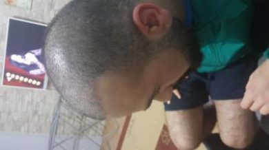 serkan-aygin-hair-transplant (10)