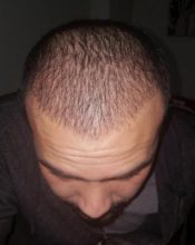 serkan-aygin-hair-transplant (11)