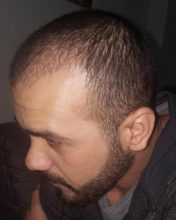 serkan-aygin-hair-transplant (12)