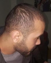 serkan-aygin-hair-transplant (13)