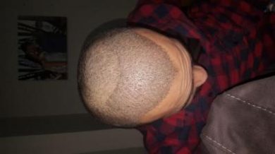 serkan-aygin-hair-transplant (5)