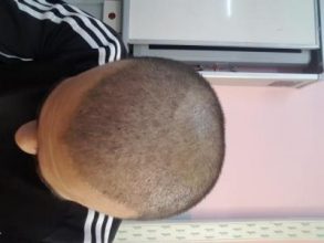 serkan-aygin-hair-transplant (6)