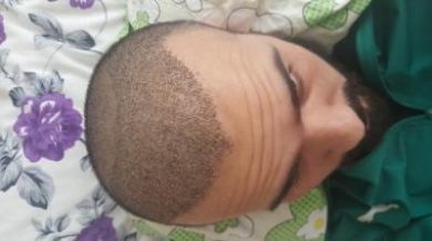 serkan-aygin-hair-transplant (7)
