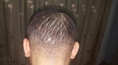 serkan-aygin-hair-transplant (8)