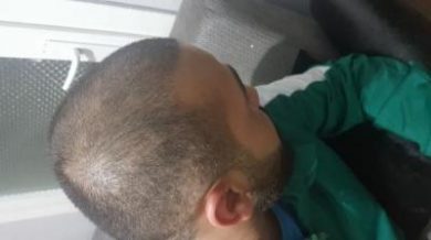 serkan-aygin-hair-transplant (9)