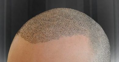 turkey-hair-transplant