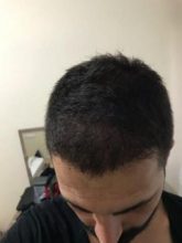 arenamed-hair-transplant-result (1)