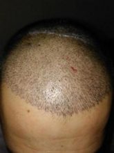 arenamed-hair-transplant-result (10)