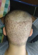 arenamed-hair-transplant-result (11)