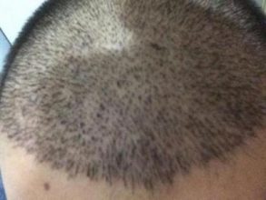 arenamed-hair-transplant-result (13)