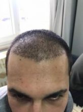 arenamed-hair-transplant-result (14)