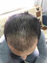 arenamed-hair-transplant-result (15)
