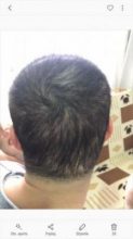 arenamed-hair-transplant-result (16)