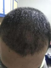 arenamed-hair-transplant-result (17)