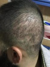 arenamed-hair-transplant-result (19)