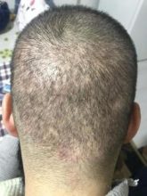 arenamed-hair-transplant-result (20)