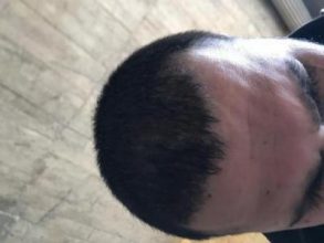 arenamed-hair-transplant-result (21)