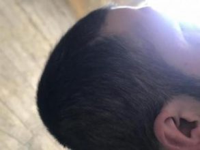 arenamed-hair-transplant-result (23)