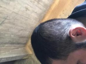 arenamed-hair-transplant-result (24)