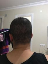 arenamed-hair-transplant-result (25)