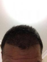 arenamed-hair-transplant-result (26)