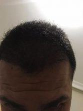 arenamed-hair-transplant-result (27)