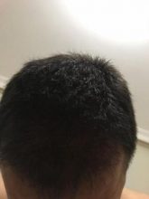 arenamed-hair-transplant-result (28)