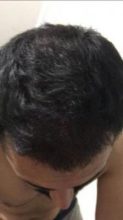 arenamed-hair-transplant-result (29)